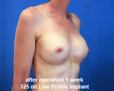 plastic-surgery-breast-augmentation
